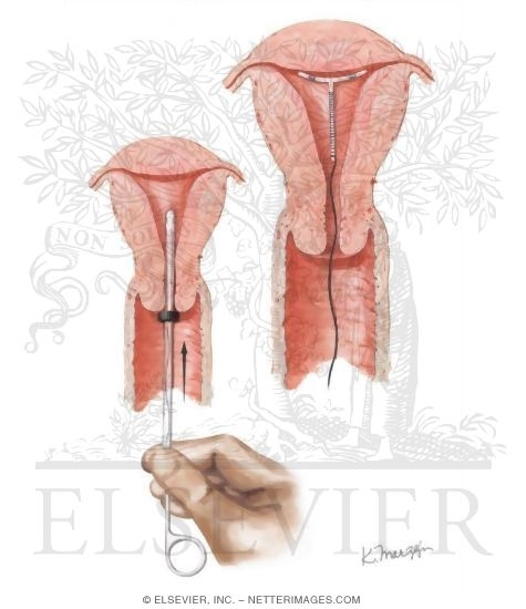 Dispozitive contraceptive intrauterine